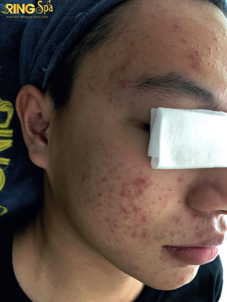 làm thế nào để da bớt mụn