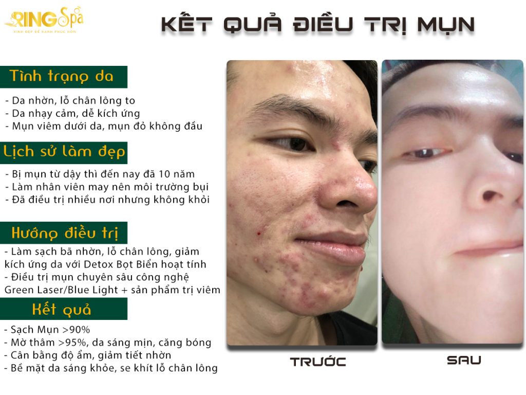 spa điều trị mụn dậy thì uy tín cho nam giới