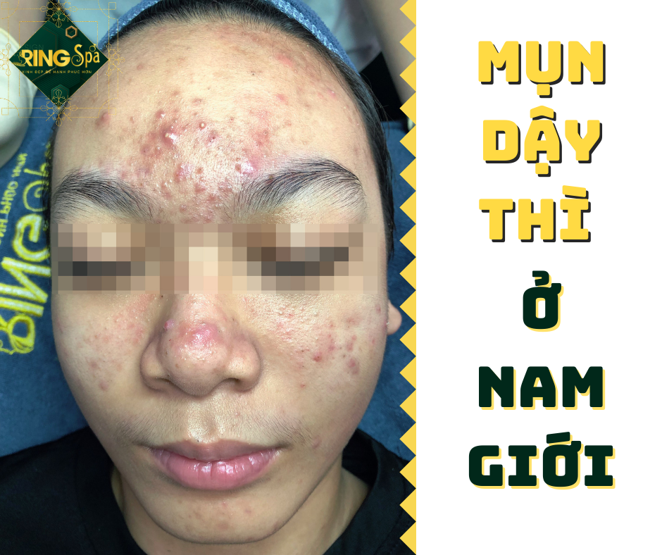 Mụn dậy thì ở nam giới