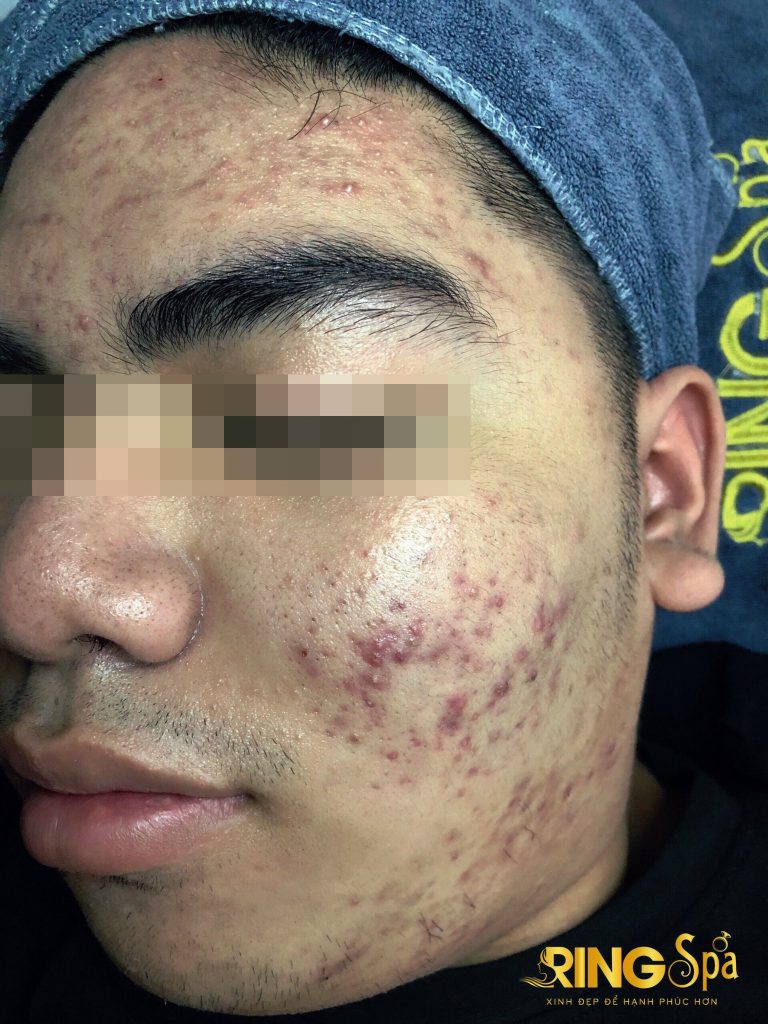 địa chỉ điều trị mụn tuổi dậy thì uy tín tphcm