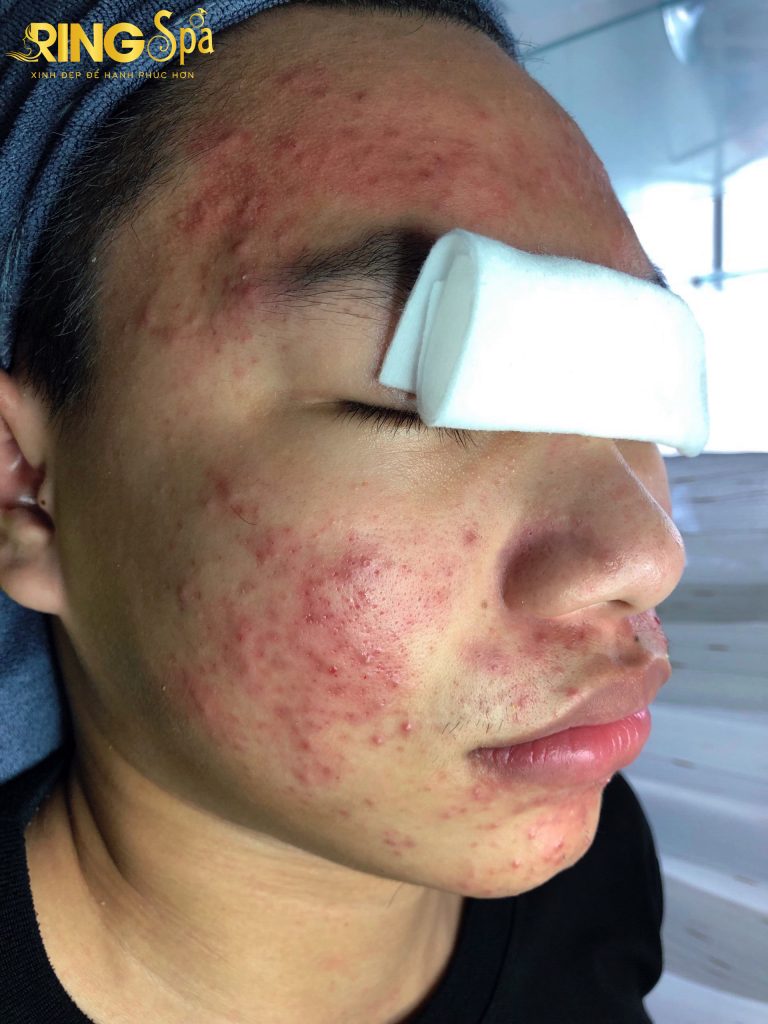 địa chỉ điều trị mụn tuổi dậy thì uy tín tphcm